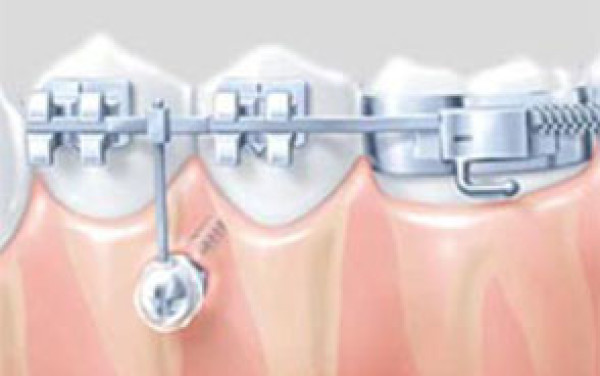 Les minivis en orthodontie