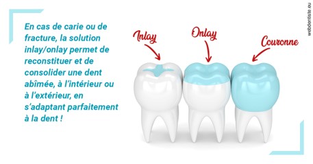 https://www.orthosante.be/L'INLAY ou l'ONLAY