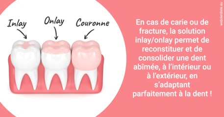 https://www.orthosante.be/L'INLAY ou l'ONLAY 2