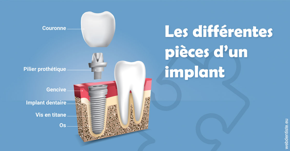 https://www.orthosante.be/Les différentes pièces d’un implant 1